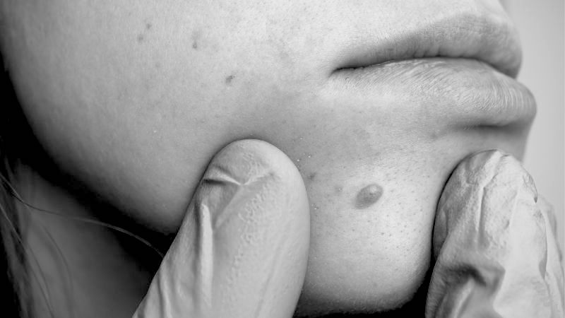 Cost of Skin Tags Removal Treatment in Milton Keynes