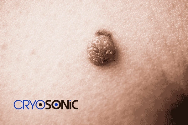 Looking for non surgical Dermatofibroma removal Milton Keynes? Contact us today Milton Keynes