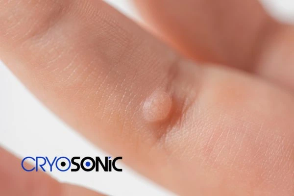 Contact Cryosonic today to learn more about us Milton Keynes now! Milton Keynes