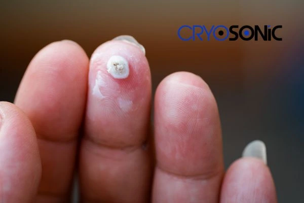 Learn more about us Milton Keynes at Cryosonic. Book in today! Milton Keynes