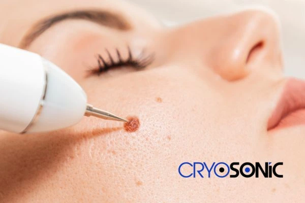 why choose us at Cryosonic for blemish removal? Find out more now Milton Keynes