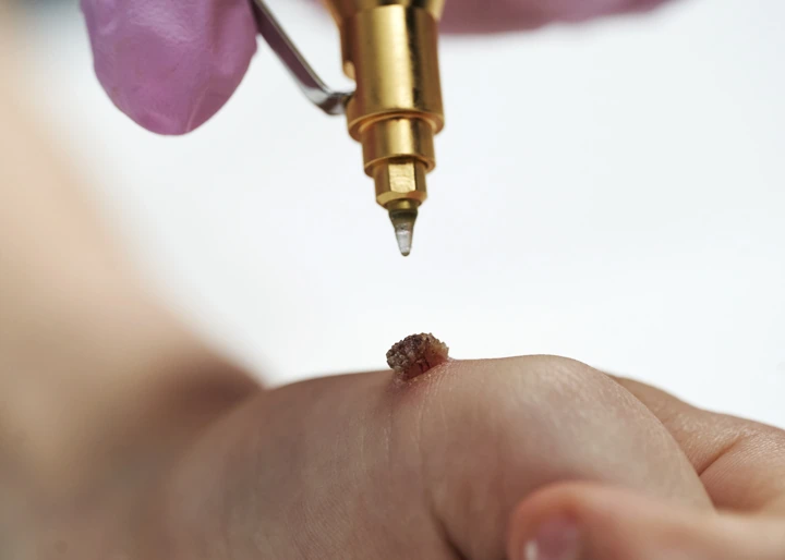 Cryopen For Children Bristol Milton Keynes