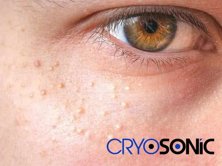 Cryosonic&rsquo;s CryoPen Approach to Milia Removal Milton Keynes Milton Keynes