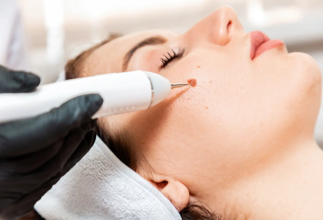 Frequently Asked Questions About Multiple Cryotherapy Treatments Milton Keynes