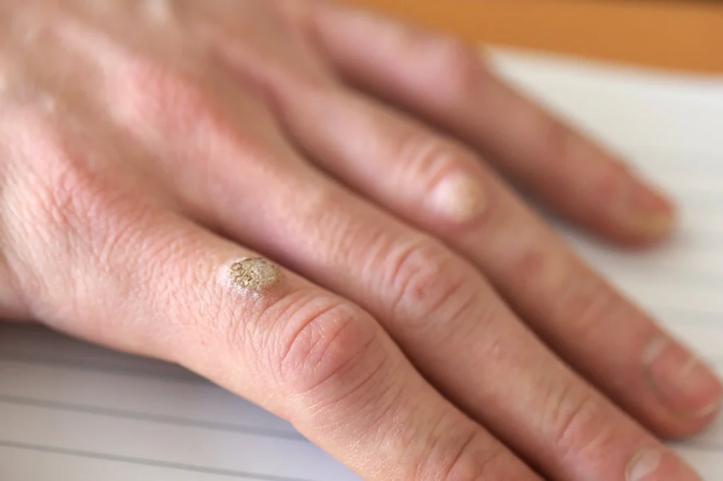 What to Expect After Warts Removal in Milton Keynes Milton Keynes