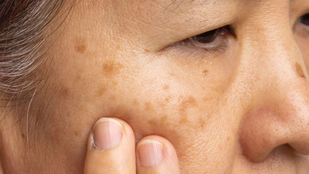 Seborrhoeic Keratosis Healing Process and Aftercare Advice Milton Keynes