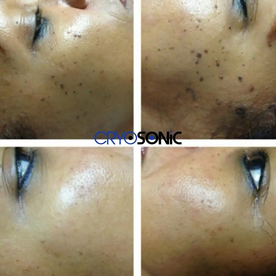 Why Skin Shows Pigmentation After Treatment Milton Keynes
