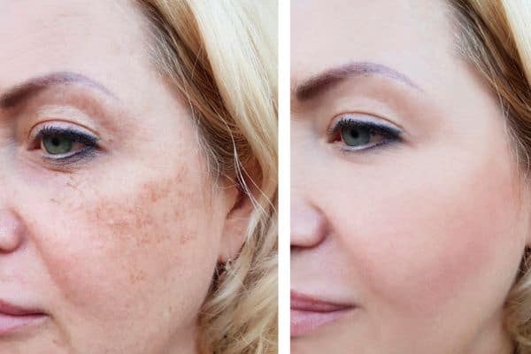 Before and after Ephelides Treatment Milton Keynes