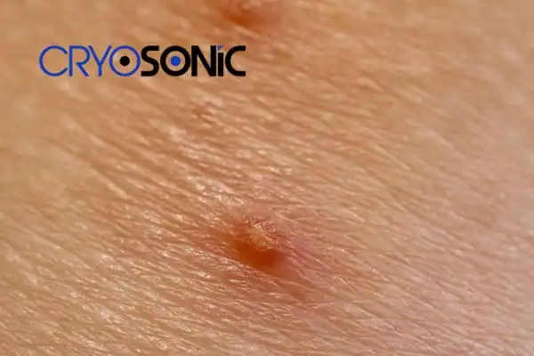 Molluscum Contagiosum Treatment Milton Keynes Milton Keynes