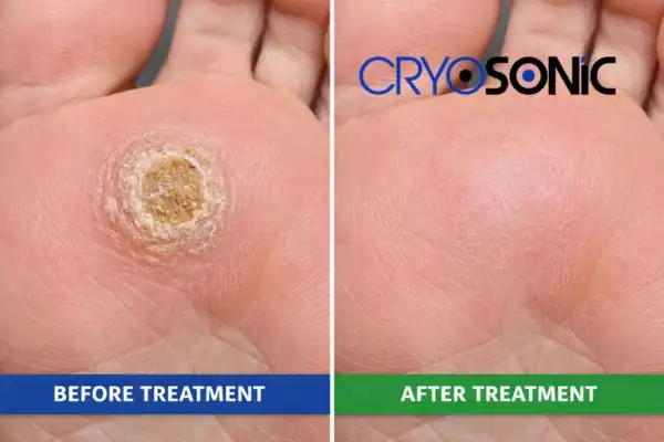 Before and after results of Porokeratosis Treatment Milton Keynes Milton Keynes
