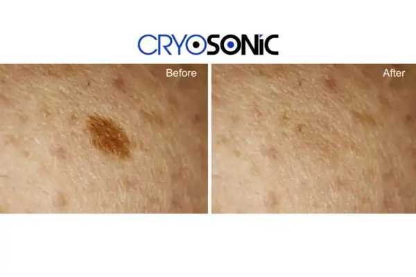 Before and after age spot removal Milton Keynes Milton Keynes