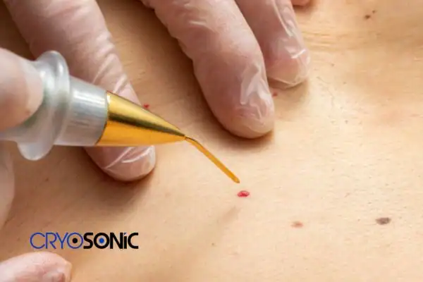 Image of cherry angioma removal Milton Keynes Milton Keynes