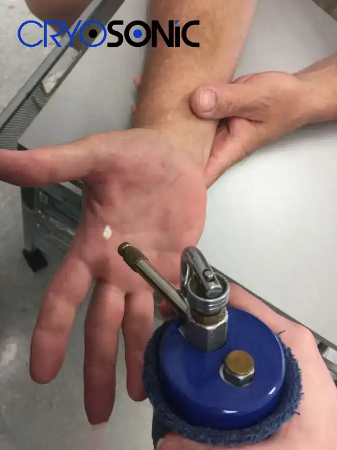Temperature Differences: OTC vs Medical-Grade Cryotherapy Milton Keynes